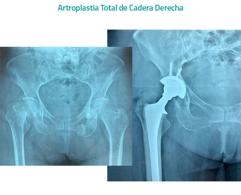 Cirugia de Artroplastia Total De Cadera