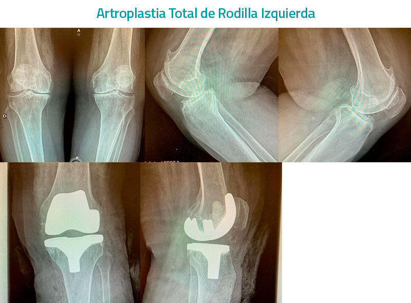 Cirugia de Artroplastia Total De Rodilla