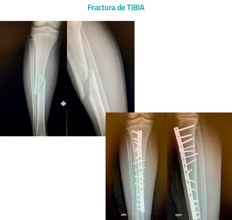 Fractura-de-TIBIA
