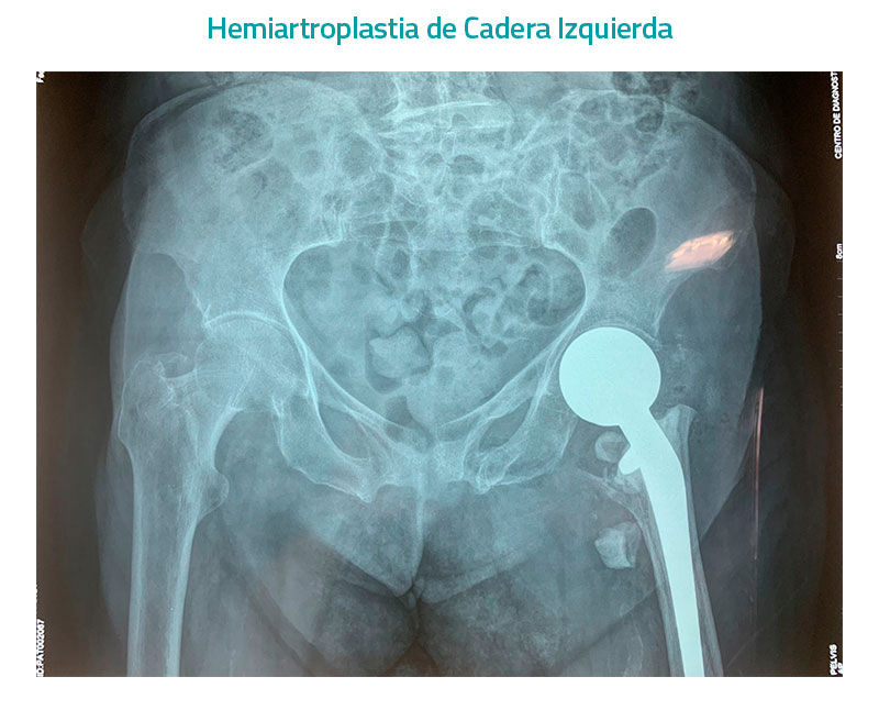 Hemiartroplastia de cadera izquierda